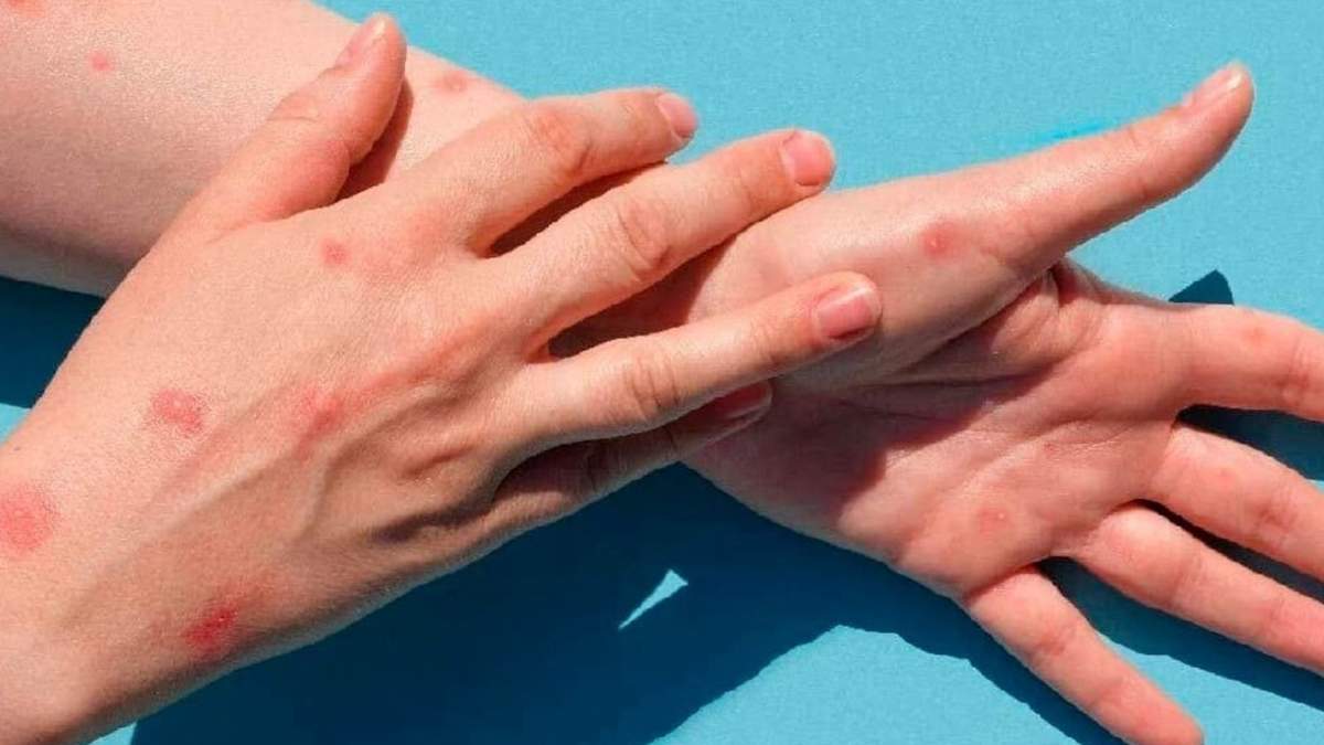 La viruela del mono ha generado preocupación mundial. Fuente: (X)