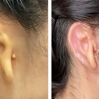 Científicos reconstruyen una oreja gracias a tejido de células humanas impreso en 3D