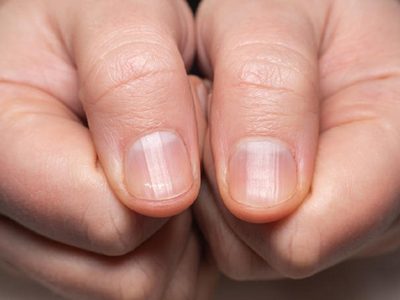 Tomá nota: eliminá las rayas de tus uñas con estos ingredientes de tu cocina muy económicos