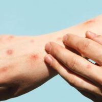Mpox registra un aumento del 860% de casos en México durante 2025