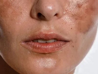 Manchas después del sol: por qué podrían ser melasma y no simples marcas del verano