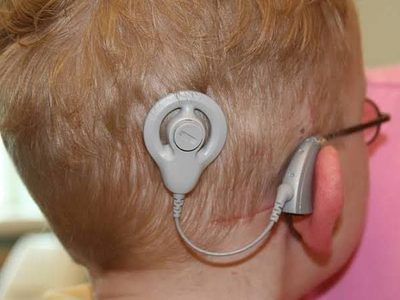 La Corte abre la puerta a que niños del IMSS obtengan implantes cocleares