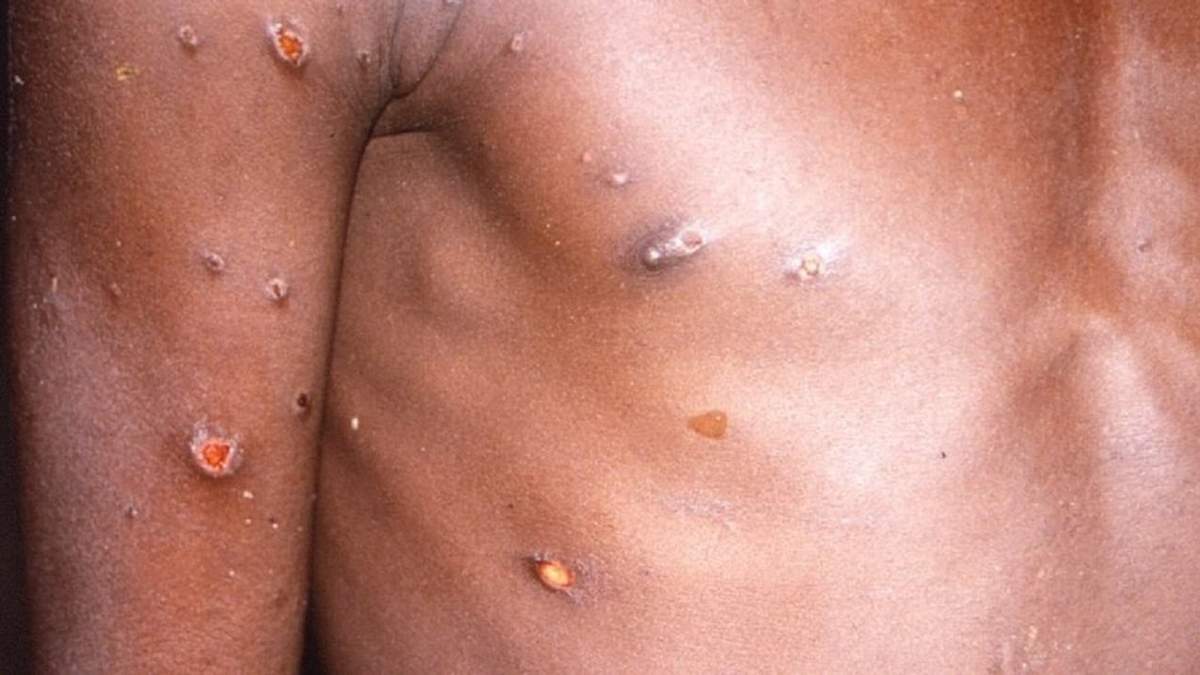 La viruela del mono produce lesiones cutáneas, fiebre y dolor corporal en las personas afectadas por el virus