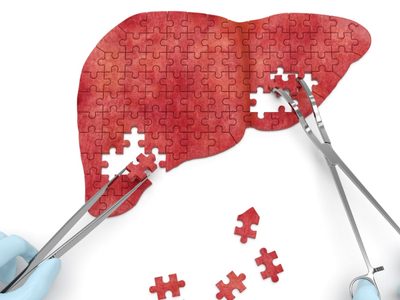 Fue detectado el primer caso de hepatitis aguda: ya van 169 casos en 12 países