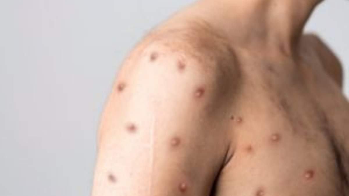 Paciente con mpox
