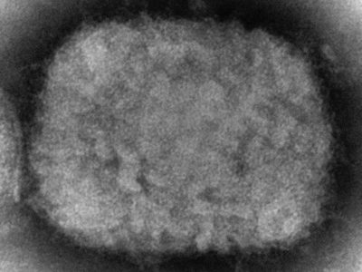 La OMS confirma más de 80 casos de la viruela del mono en 12 países