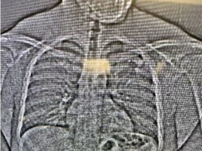 Ladrón se traga aretes de diamantes durante su arresto