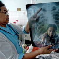 La OMS alertó sobre otra crisis sanitaria: la pandemia hizo subir las muertes por tuberculosis
