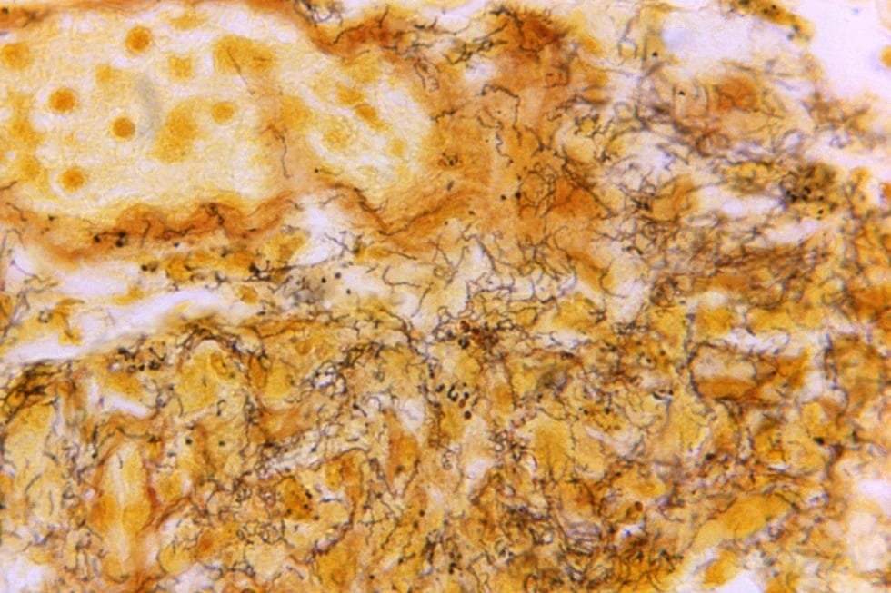 Una muestra de tejido con la presencia de numerosas espiroquetas de Treponema pallidum, la bacteria responsable de causar sífilis