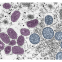 Japón confirma el primer caso de viruela del mono en el país