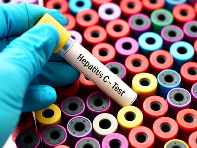 ANMAT aprobó un test de detección rápida para la hepatitis C