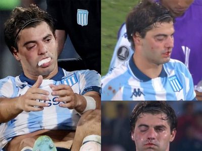 Marcos Rojo fracturó a Santi Sosa y así quedó el futbolista de Racing