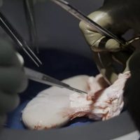 Trasplantan con éxito riñón de cerdo a hombre con muerte cerebral