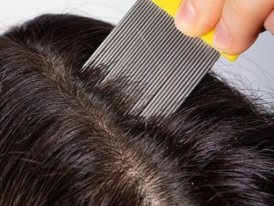 Sin productos carísimos: la fórmula mágica para eliminar los piojos en solo unos días