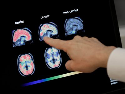 Vivir más tiempo podría aumentar el riesgo de demencia, pero hay formas de reducirlo