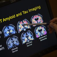 ¿Análisis de sangre para detectar el Alzheimer? Esto es lo que se sabe
