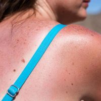 Si vas de vacaciones a la playa: conocé los riesgos de las quemaduras solares y cómo cuidar mejor tu piel