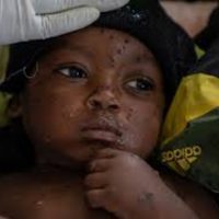 Una ciudad minera en el Congo es foco de la viruela del mono mientras se propaga una nueva cepa