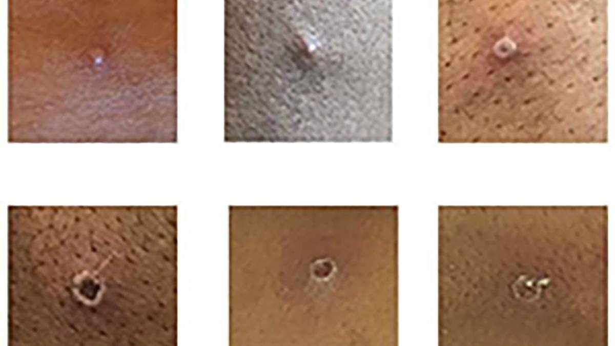 Detalles de viruela del mono en la piel