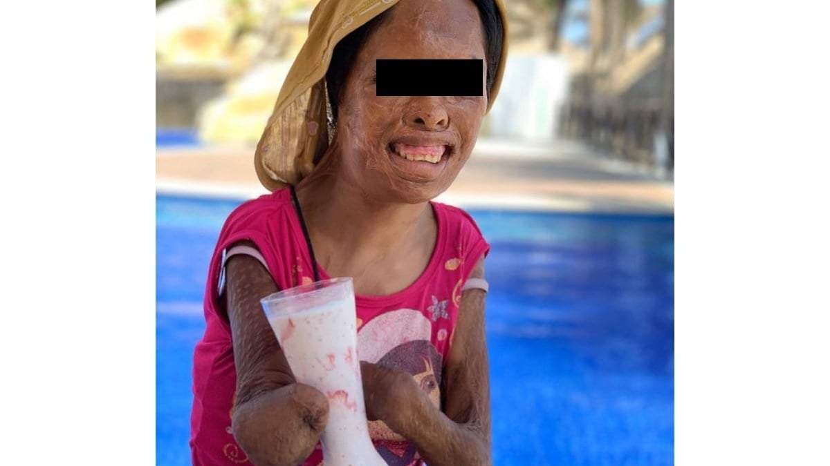 Juanita perdió extremidades a causa de los abusos de su padre