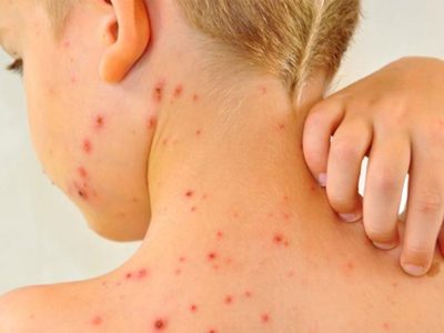 Neuquén confirma que no hay casos de sarampión, pero pide completar vacunas