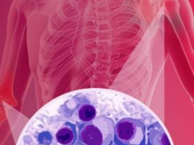 Sobrevida de personas con Mieloma Múltiple se duplica en México: SSA