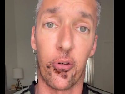 Actor porno comparte su experiencia al contagiarse de viruela del mono: "las lesiones son brutales"