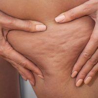 Si ya no sabés qué inventar para reducir la celulitis y la retención de líquidos en tu figura, seguí estos efectivos tips