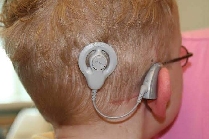 Implante para niños derechohabientes del IMSS. Ruta legal