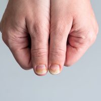 Con 2 ingredientes caseros: el ungüento infalible para eliminar los hongos de las uñas
