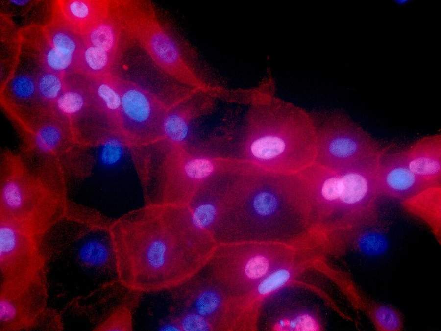 Células de cáncer