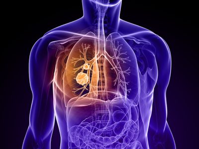 El 15% de los pacientes de cáncer de pulmón no son fumadores: la contaminación es la culpable