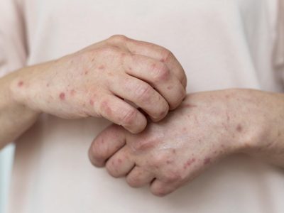 El ministerio de Salud de Mendoza pidió fortalecer la vigilancia por casos de sarampión