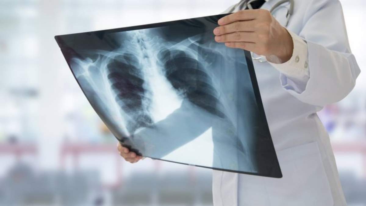 Factores ambientales como ciertas bacterias o sustancias químicas podrían desencadenar la sarcoidosis