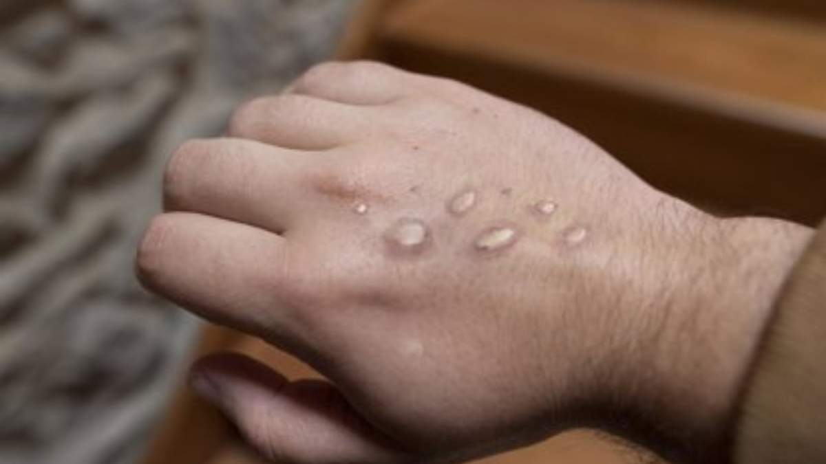 Se reportó el primer caso de mpox en Malí