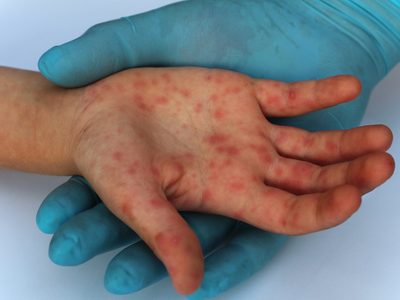 Brote de sarampión en México en medio de la crisis por la pandemia del coronavirus