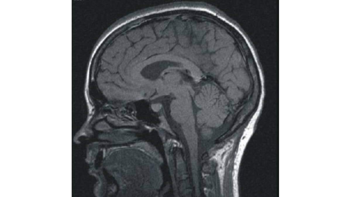 Tomografía cerebral