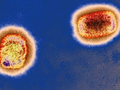 Viruela del mono: el Ministerio de Salud informó del primer caso posible