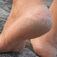 No gastes de más: prepará esta crema para talones agrietados con 4 ingredientes fáciles de conseguir