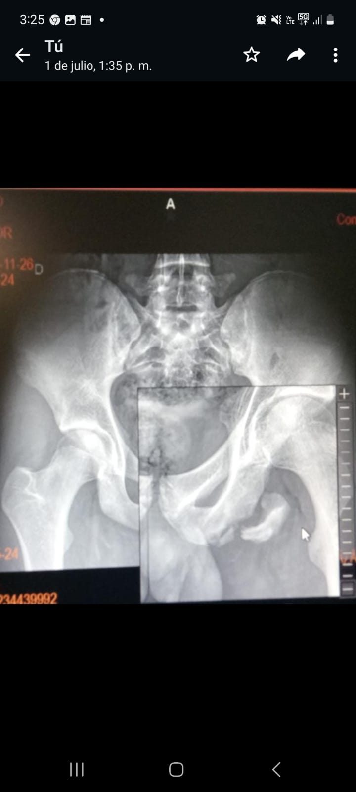 RADIOGRAFIA-HEPTATLETA