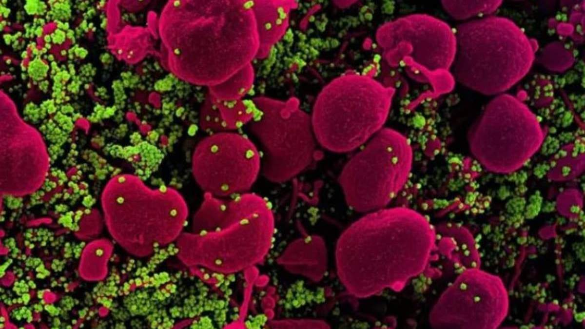 Célula apoptótica (rosa) infectada con partículas del SARS-COV-2 (verde)