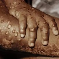 Emergencia sanitaria en África: Hay aumento y propagación rápida de "viruela del mono" (virus mpox)