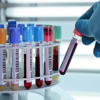 En la segunda ola de contagios, Zapala superó los 400 casos activos de coronavirus