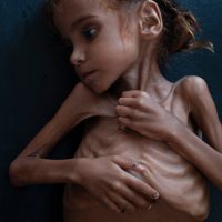 Muere Amal Hussain, el rostro de la hambruna y la guerra en Yemen