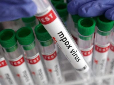 Confirman el primer caso de viruela del mono en Neuquén: qué se sabe sobre el origen