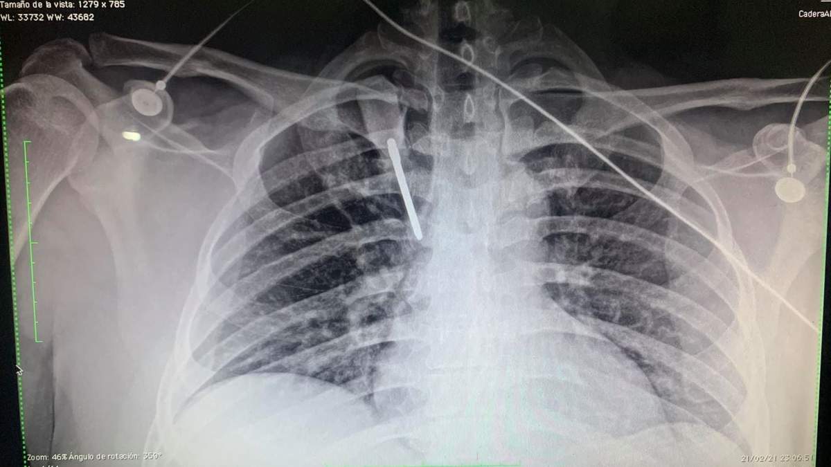 Radiografía tomada al médico en el que se observa el desarmador aún enterrado