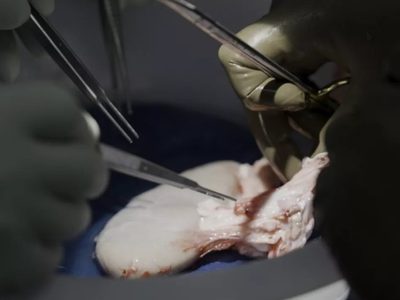 Trasplantan con éxito riñón de cerdo a hombre con muerte cerebral
