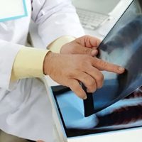 Los casos de tuberculosis en Neuquén se incrementaron un 20 por ciento en los últimos dos años