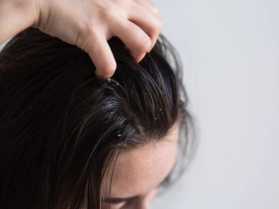 El secreto para eliminar la caspa de tu cabello en tiempo récord y sin gastar una fortuna