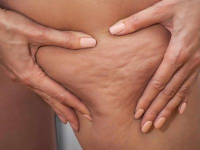 El secreto natural y saludable para combatir la desagradable celulitis